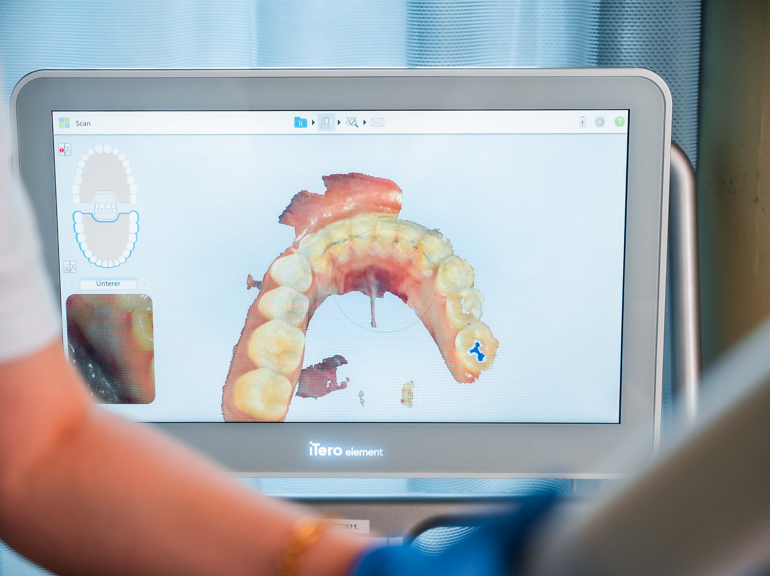 Digitaler 3D-Scan der Zähne am iTero Scanner